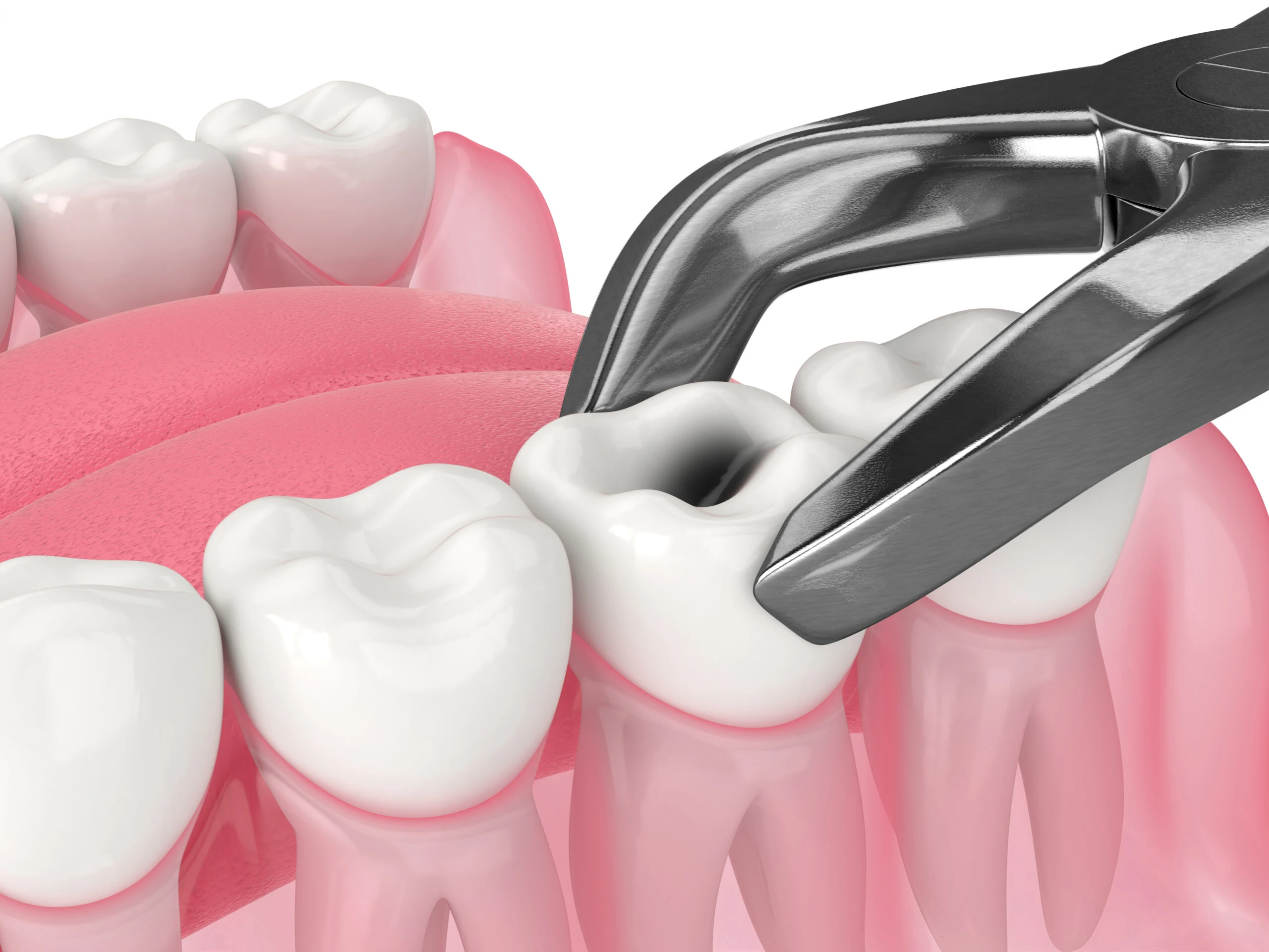 What is a Tooth Extraction?