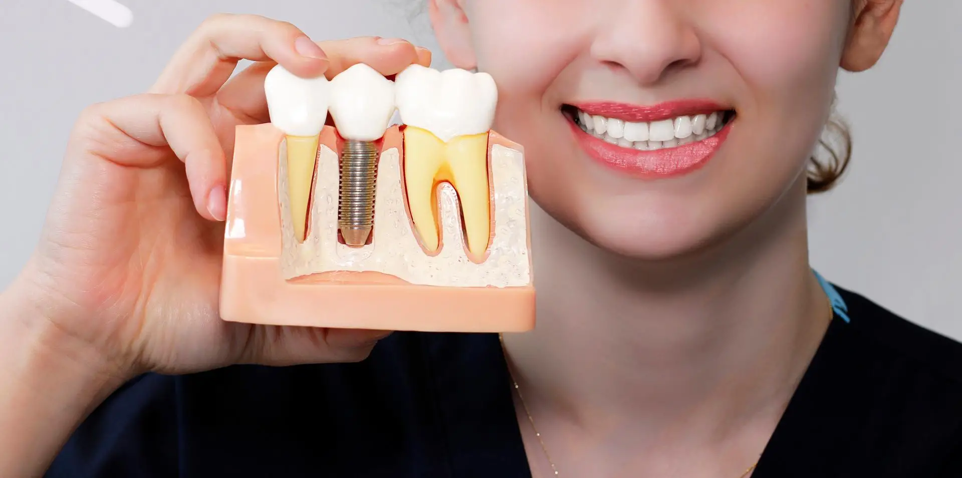 Dental Implants