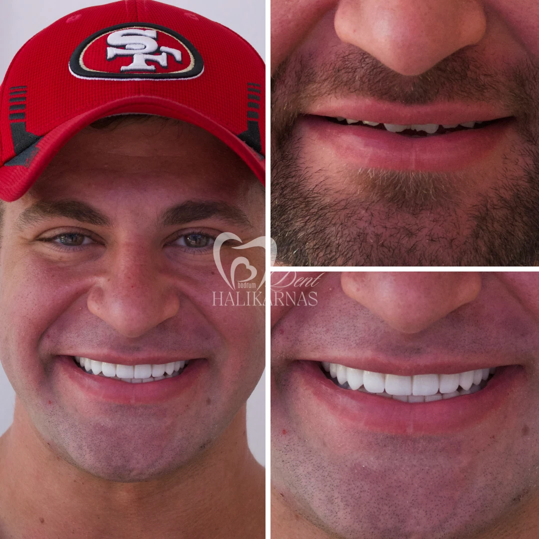 Discover Our Patients<br>Smile Transformations