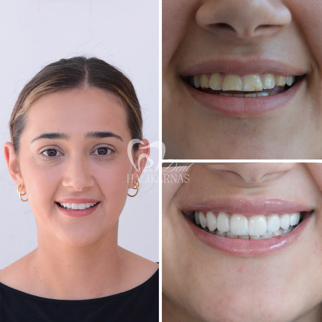 Discover Our Patients<br>Smile Transformations